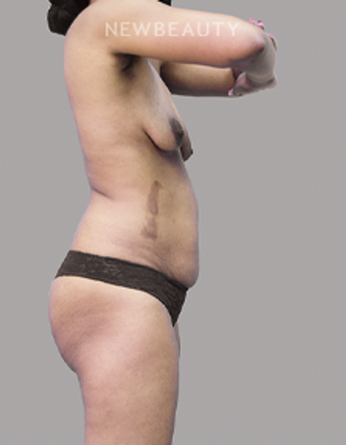 Dr. Olga Bachilo - Mommy Makeover - 28651905 - Before