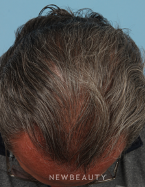 Dr. Kathleen Behr - Hair Loss Treatment - Before