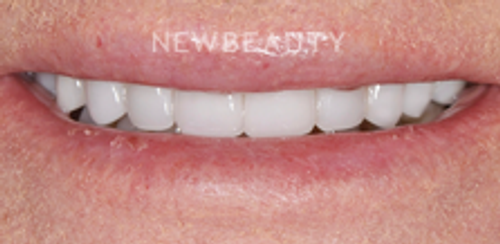 Dr. Salvator La Mastra - Smile Makeover -46106900 - After