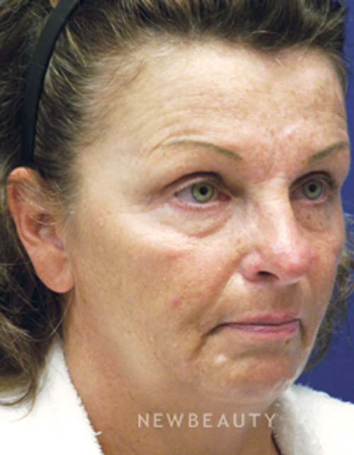 Dr. Adam Summers - SMART FACELIFT™ - Before