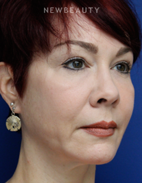 Dr. Joseph Russo - Restoring Youthfulness (Face EBG) - Before
