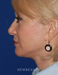 Dr. Konstantin Vasyukevich - Facelift - After