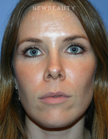 Dr. Kelly Bomer - Liquid Facelift - Before