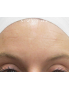 Dr. Jody Levine - Chemical Peel - After
