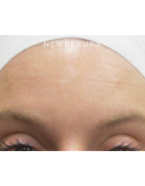 Dr. Jody Levine - Chemical Peel - After