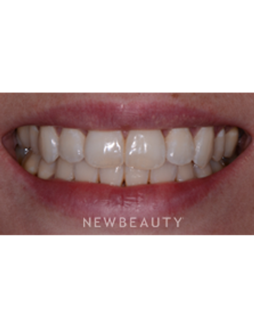 Dr. Irene Grafman - Cosmetic Bonding - Before