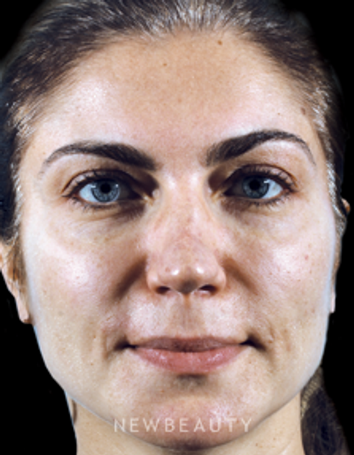 Dr. Marina Peredo - Lip Filler and Cheek Augmentation - Before