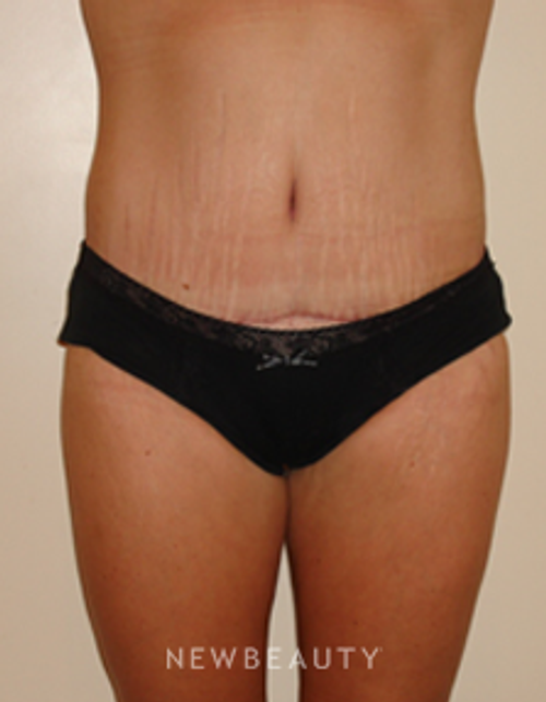 Dr. Michael Horn Tummy Tuck - After