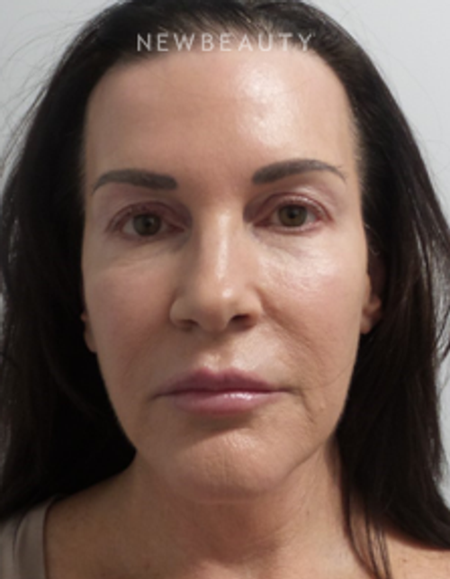 Dr. Marina Peredo - Facelift - Before