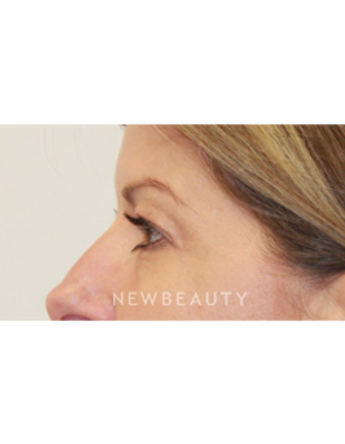 Dr. Dilip D. Madnani - Eyelift - Before