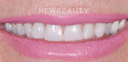 Dr. Salvator La Mastra - Smile Makeover -46100874 - Before