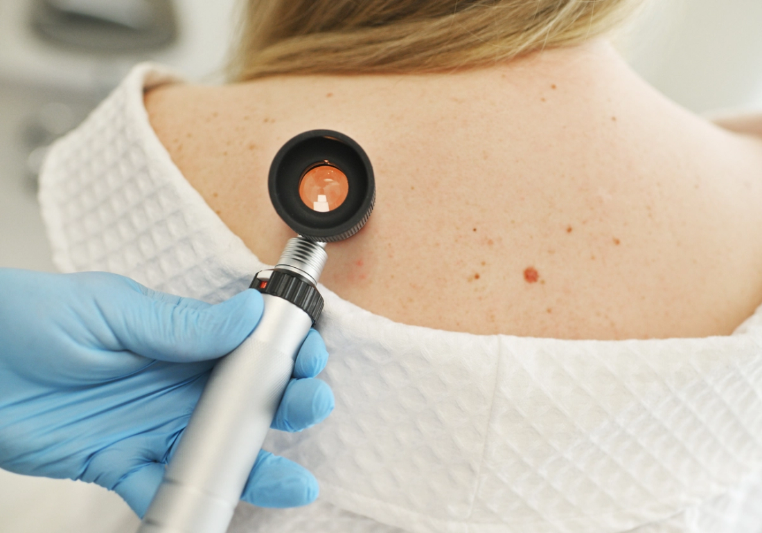 close-up - a dermatologist examines moles and skin growths on the patient's body using a special device - a dermatoscope. Diagnosis and prevention of melanoma.