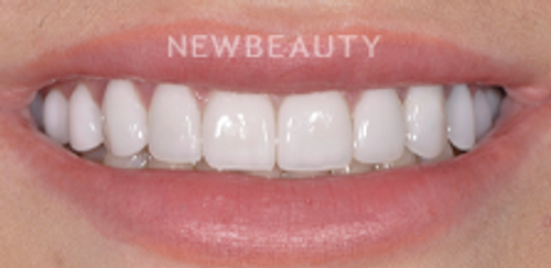 Dr. Salvator La Mastra – Smile Makeover – 46107128 - After