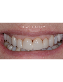 Dr. Guy Lewis - Veneers - Before