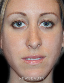 Dr. Kelly Bomer Rhinoplasty - After