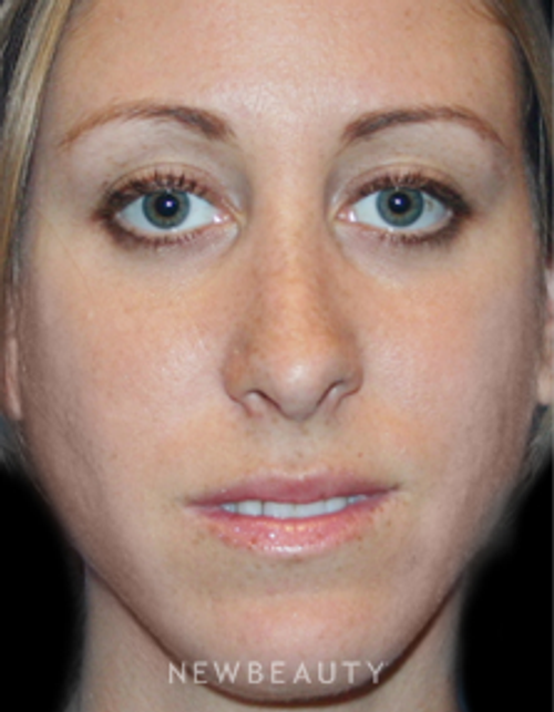 Dr. Kelly Bomer Rhinoplasty - After