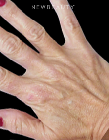 Dr. Kenneth R. Beer - Hand Rejuvenation - Before
