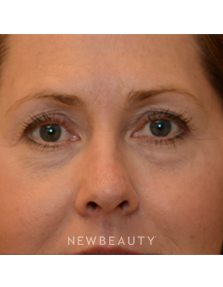 Dr. Janet Allenby - Kybella - Before