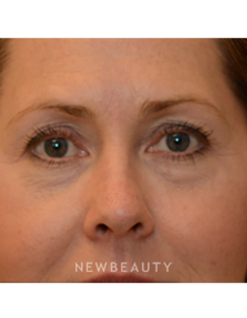 Dr. Janet Allenby - Kybella - Before