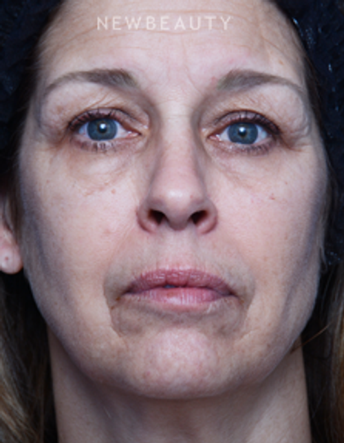 Dr. Alan Durkin - Facelift - Before