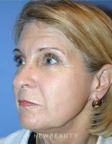 Dr. Kelly Bomer Liquid Facelift - Before