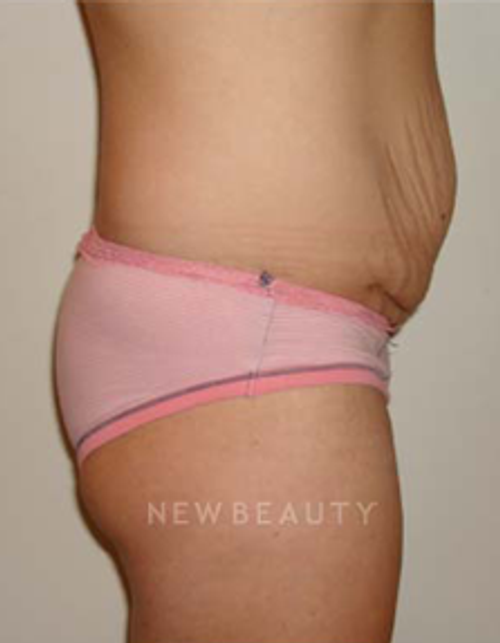 Dr. Michael Horn Tummy Tuck - Before