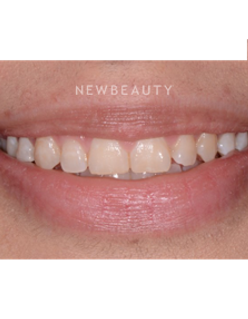 Dr. Irene Grafman - Dental Bonging - Before