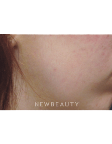 Dr. Jody Levine Lasers - After