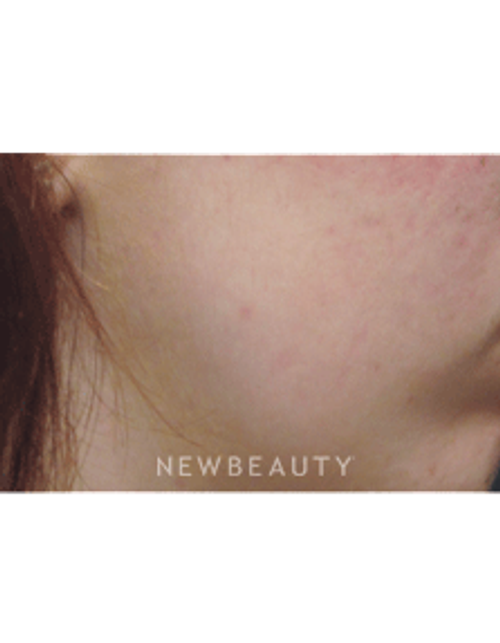 Dr. Jody Levine Lasers - After