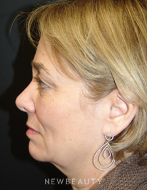 Dr. Mokhtar Asaadi Eyelid Lift - Before