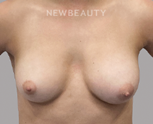 Dr. Christine Hamori – Breast Augmentation – 52892616 - Before