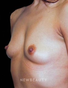 Dr. Roman Rayham - Enhancing Beauty - Before