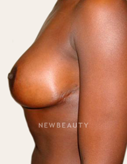 Dr. Michael Horn Breast Lift - After