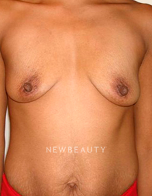Dr. Michael Horn Breast Augmentation - Before