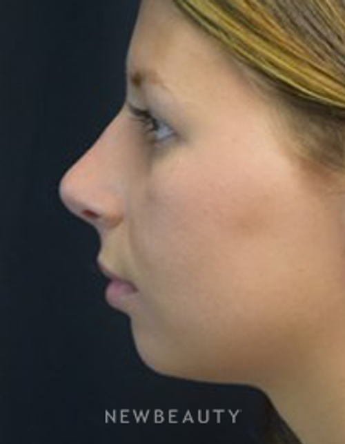 Dr. Jeffrey B. Wise - Rhinoplasty - After