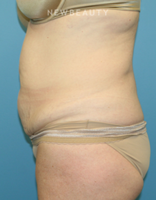 Dr. Christine Hamori - Tummy Tuck with Liposuction - Before