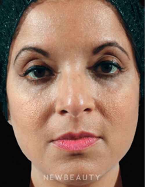 Dr. Marina Peredo Injectables & Fillers - After