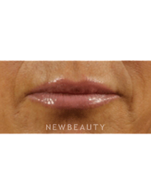 Dr. Marina Peredo Lip Augmentation - After