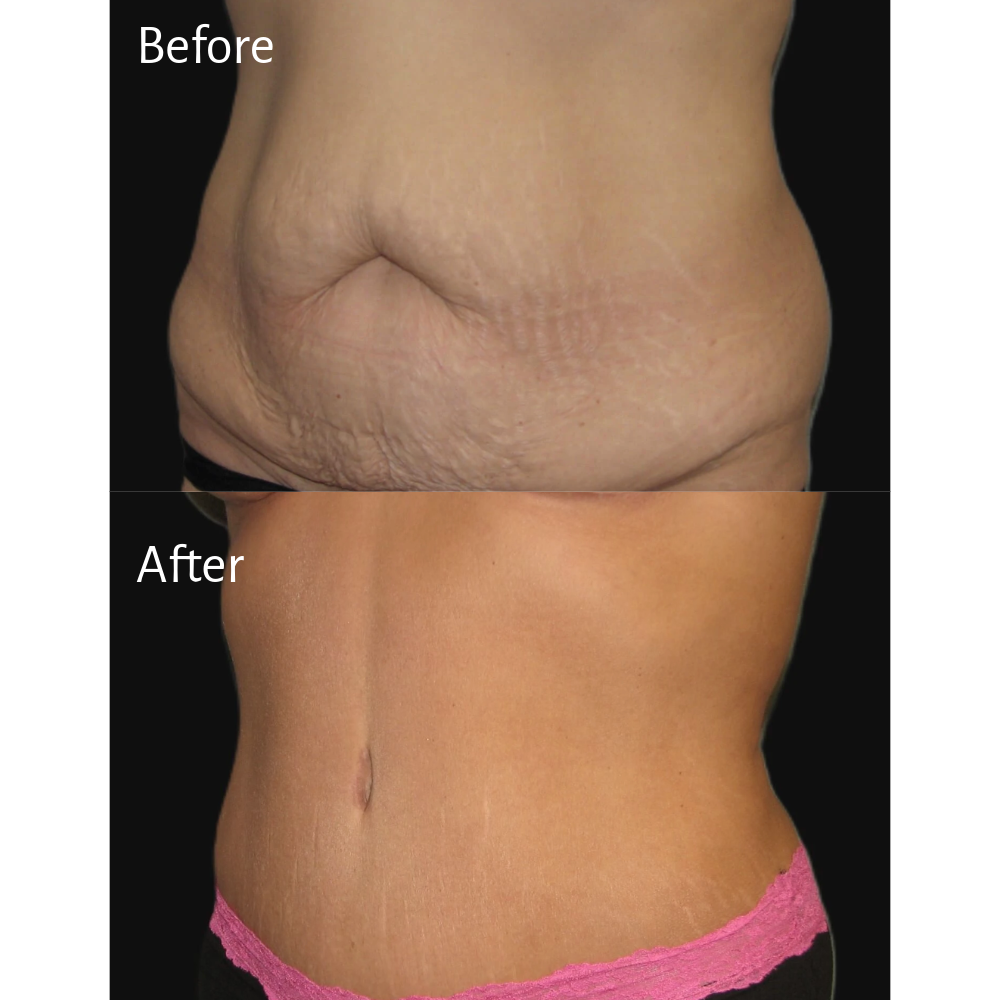 Dr. Sean Simon before and after Procedure: Tummy Tuck