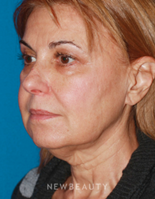 Dr. Konstantin Vasyukevich, Traditional Facelift - Before