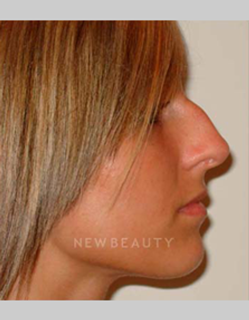 Dr. Michael Horn Rhinoplasty - Before