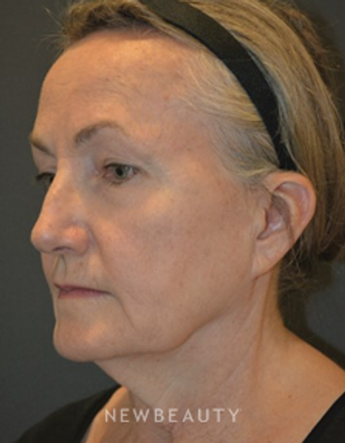 Dr. Aviva Preminger - Facelift - Before