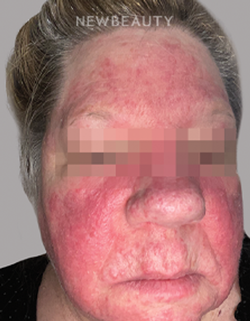 Dr. Anna Chacon - Rosacea - 34278072 - Before