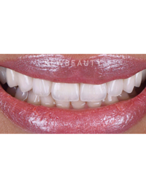 Dr. Husam Almunajed - Smile Makeover Revision - After