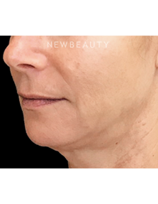 Dr. Janet Allenby - Liquid Facelift - Before