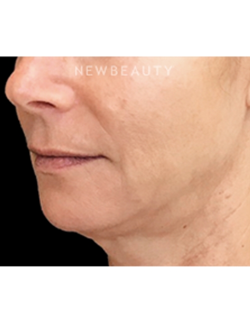Dr. Janet Allenby - Liquid Facelift - Before
