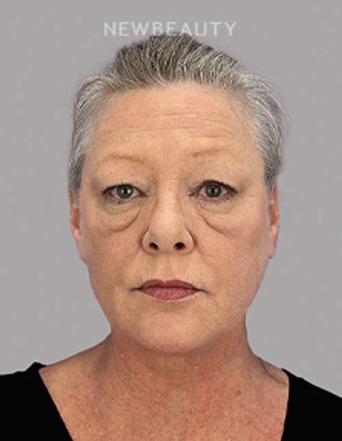 Dr. Sheila Barbarino-Lower Blepharoplasty, Upper Blepharoplasty-54799251 - Before