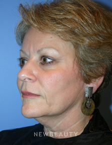 Dr Kelly V. Bomer Liquid Facelift - Before