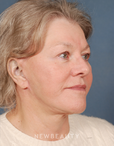 Dr. Bradley Calobrace Facelift - After