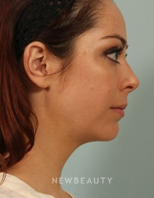 Dr. Kenneth Beer - Kybella - After